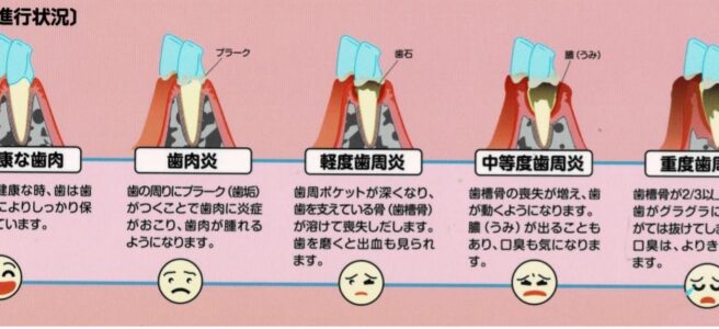 歯周病の進行状況