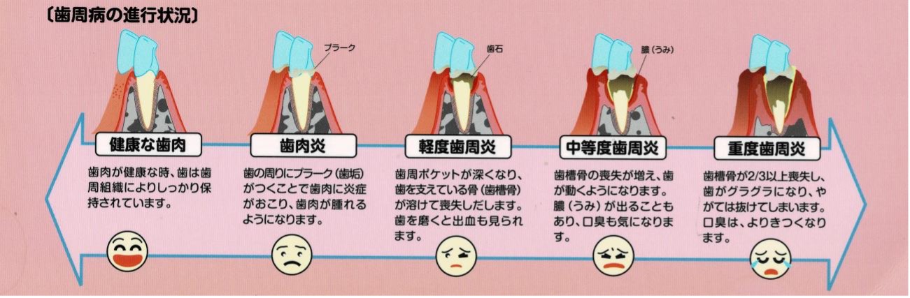 歯周病の進行状況